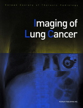 Imaging of Lung Cancer